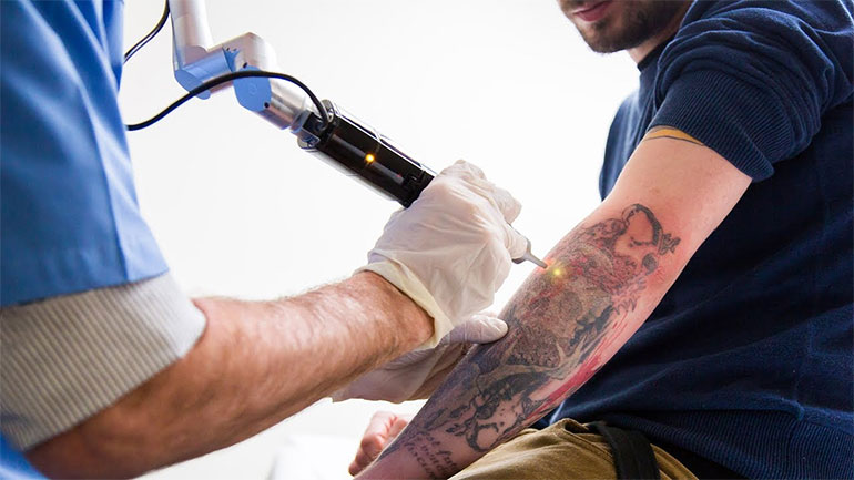 Eliminación de tatuajes con láser