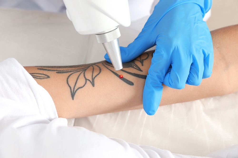 Todo sobre la eliminación de tatuajes